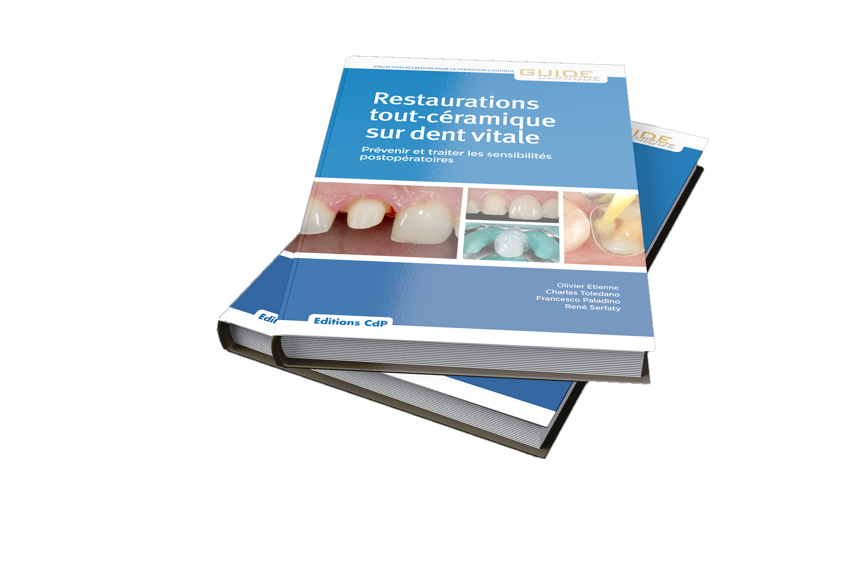 Restaurations tout-céramique sur dent vitale